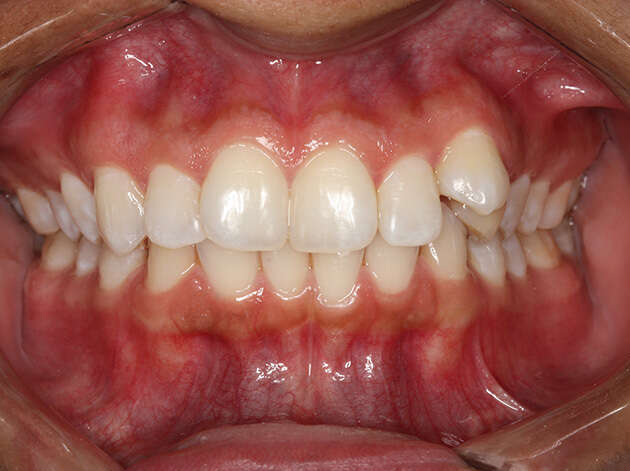 Close up of teeth and gums before Invisalign orthodontics