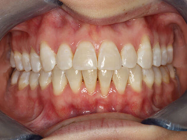 Close up of teeth and gums after Invisalign orthodontics