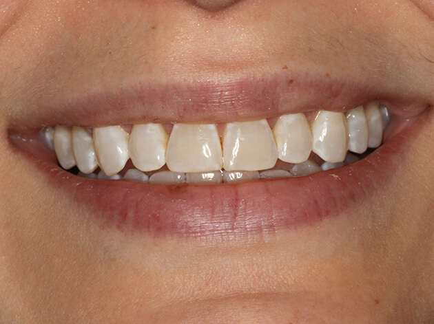 Close up of smile after Invisalign orthodontics