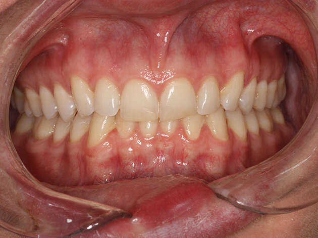 Close up of teeth and gums before Invisalign orthodontics