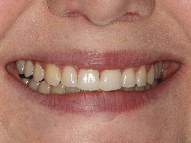 Close up of smile after Invisalign orthodontics