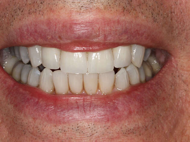Close up of smile after restorative care