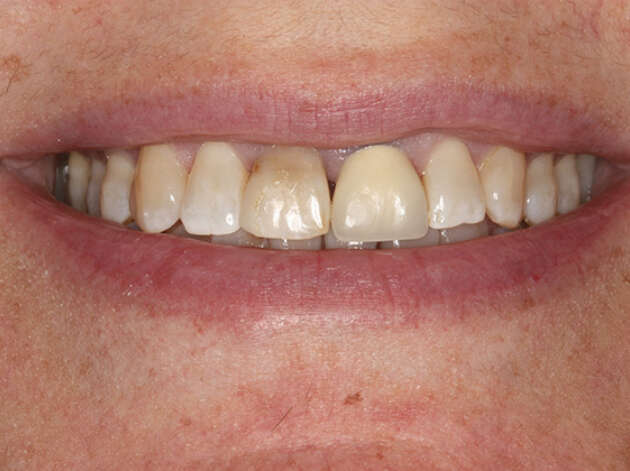 Close up of smile before anterior crown placement
