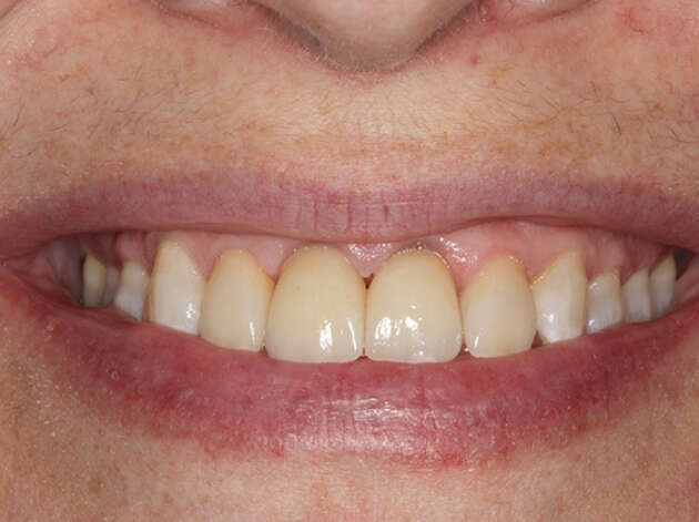 Close up of smile anterior crown placement