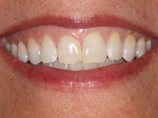 Close up of smile before Invisalign orthodontics and veneers