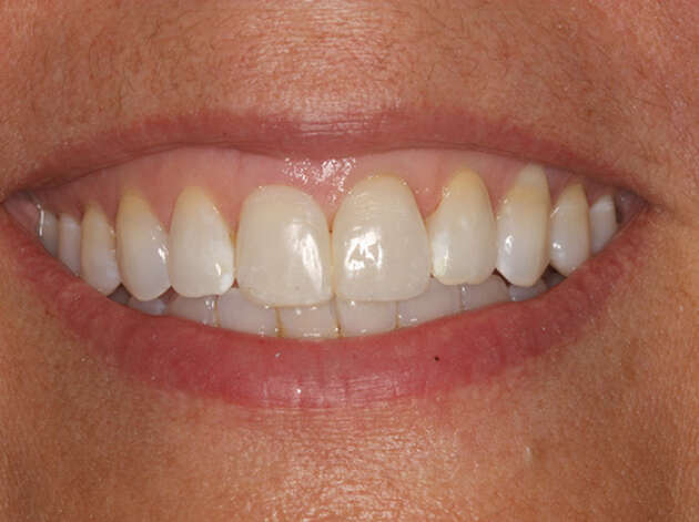 Close up of smile after Invisalign orthodontics and veneers