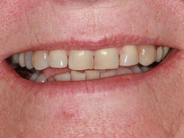 Close up of smile before restorative care